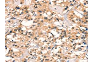 The image on the left is immunohistochemistry of paraffin-embedded Human thyroid cancer tissue using ABIN7129096(CUEDC2 Antibody) at dilution 1/30, on the right is treated with fusion protein. (CUEDC2 anticorps)