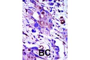 Formalin-fixed and paraffin-embedded human cancer tissue reacted with the primary antibody, which was peroxidase-conjugated to the secondary antibody, followed by AEC staining.