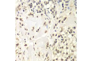 Immunohistochemistry of paraffin-embedded human kidney cancer using USP7 antibody (ABIN6293331) at dilution of 1:200 (40x lens). (USP7 anticorps)