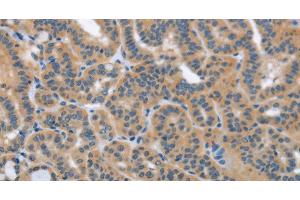 Immunohistochemistry of paraffin-embedded Human thyroid cancer using HSD3B1 Polyclonal Antibody at dilution of 1:40 (HSD3B1 anticorps)