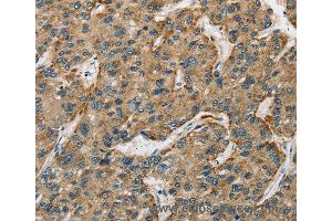 Immunohistochemistry of Human liver cancer using CTSE Polyclonal Antibody at dilution of 1:50 (Cathepsin E anticorps)