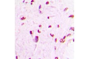 Immunohistochemical analysis of MEF2C staining in human lung cancer formalin fixed paraffin embedded tissue section.