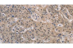 Immunohistochemistry of paraffin-embedded Human gastric cancer using DPYSL3 Polyclonal Antibody at dilution of 1:30 (DPYSL3 anticorps)