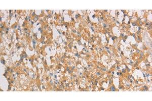 Immunohistochemistry of paraffin-embedded Human thyroid cancer tissue using ART3 Polyclonal Antibody at dilution 1:40 (ART3 anticorps)