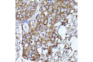 Immunohistochemistry of paraffin-embedded human colon carcinoma using N-WASP/WASL antibody (ABIN3016273, ABIN3016274, ABIN3016275, ABIN1683282 and ABIN6219682) at dilution of 1:100 (40x lens). (Neural Wiskott-Aldrich syndrome protein (WASL) (AA 1-250) anticorps)