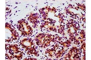 IHC image of ABIN7127755 diluted at 1:100 and staining in paraffin-embedded human breast cancer performed on a Leica BondTM system.