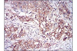 Immunohistochemical analysis of paraffin-embedded cervical cancer tissues using EIF2AK2 mouse mAb with DAB staining.