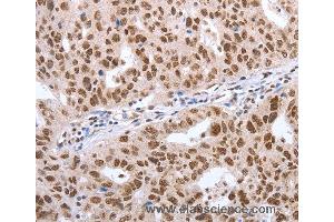 Immunohistochemistry of Human lung cancer using POU3F1 Polyclonal Antibody at dilution of 1:40 (POU3F1 anticorps)
