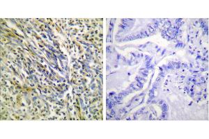 Cl-Peptide - +Immunohistochemical analysis of paraffin-embedded human lung carcinoma tissue using Aggrecan (Cleaved-Asp369) antibody (#L0101). (Aggrecan anticorps  (Cleaved-Asp369))