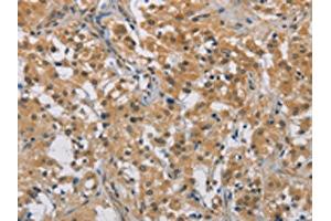 The image on the left is immunohistochemistry of paraffin-embedded Human thyroid cancer tissue using ABIN7129183(DDX43 Antibody) at dilution 1/50, on the right is treated with fusion protein. (DDX43 anticorps)