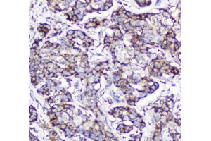 IHC testing of FFPE human breast cancer with Cytochrome C antibody at 2ug/ml. (Cytochrome C anticorps  (AA 2-105))