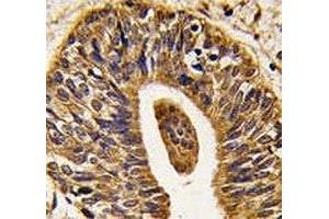 IHC analysis of FFPE human prostate carcinoma tissue stained with anti-HER2 antibody