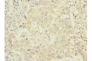 Immunohistochemistry of paraffin-embedded human liver cancer using ABIN7155913 at dilution of 1:100