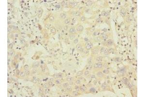 Immunohistochemistry of paraffin-embedded human liver cancer using ABIN7155913 at dilution of 1:100 (HCFC1R1 anticorps  (AA 1-119))