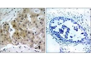 Immunohistochemistry analysis of paraffin-embedded human breast carcinoma, using VEGFR2 (Phospho-Tyr1175) Antibody. (VEGFR2/CD309 anticorps  (pTyr1175))