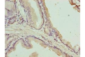 Immunohistochemistry of paraffin-embedded human prostate cancer using ABIN7174755 at dilution of 1:100 (C17orf64 anticorps  (AA 111-236))