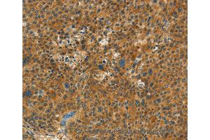 Immunohistochemistry of Human thyroid cancer using NPAP1 Polyclonal Antibody at dilution of 1:60 (NPAP1 anticorps)