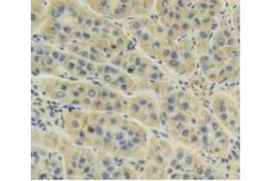 IHC-P analysis of Human Liver Cancer Tissue, with DAB staining. (AMH anticorps  (AA 453-560))