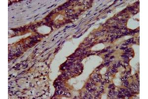 IHC image of ABIN7154126 diluted at 1:500 and staining in paraffin-embedded human colon cancer performed on a Leica BondTM system.