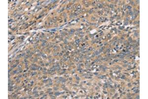 The image on the left is immunohistochemistry of paraffin-embedded Human cervical cancer tissue using ABIN7129065(CST2 Antibody) at dilution 1/50, on the right is treated with fusion protein.