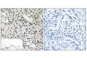 Immunohistochemistry analysis of paraffin-embedded human breast carcinoma tissue using TCEAL4 antibody. (TCEAL4 anticorps  (C-Term))