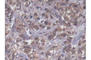 DAB staining on IHC-P; Samples: Human Breast cancer Tissue