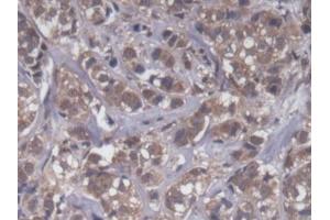 DAB staining on IHC-P; Samples: Human Breast cancer Tissue (UQCRB anticorps  (AA 2-111))