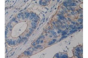 Detection of ACTN4 in Human Colorectal cancer Tissue using Polyclonal Antibody to Actinin Alpha 4 (ACTN4)