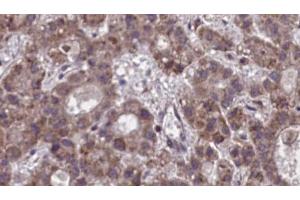 ABIN6273890 at 1/100 staining Human liver cancer tissue by IHC-P. (NPBWR1 anticorps  (C-Term))