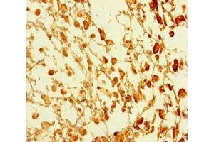 Immunohistochemistry of paraffin-embedded human melanoma using ABIN7172553 at dilution of 1:100 (GATA6 anticorps  (AA 496-595))
