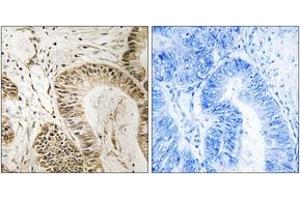 Immunohistochemistry analysis of paraffin-embedded human colon carcinoma tissue, using RGS1 Antibody. (RGS1 anticorps  (AA 118-167))