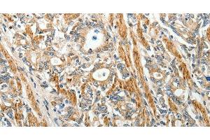 Immunohistochemistry of paraffin-embedded Human gastric cancer using E-Selectin Polyclonal Antibody at dilution of 1:40 (Selectin E/CD62e anticorps)