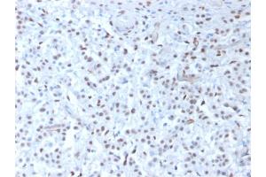 Formalin-fixed, paraffin-embedded human Mesothelioma stained with Wilm's Tumor Mouse Recombinant Monoclonal Antibody (rWT1/857). (Recombinant WT1 anticorps)