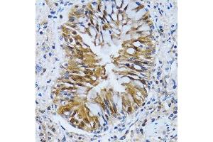 Immunohistochemistry of paraffin-embedded human lung cancer using IMPA1 antibody. (IMPA1 anticorps  (AA 1-277))