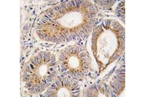 IHC analysis of FFPE human colon carcinoma tissue stained with FGF1 antibody (FGF1 anticorps  (AA 5-30))