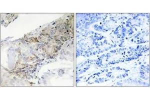 Immunohistochemistry analysis of paraffin-embedded human breast carcinoma tissue, using COX5B Antibody.