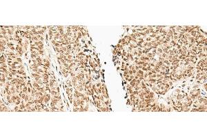 Immunohistochemistry of paraffin-embedded Human ovarian cancer tissue using FUT3 Polyclonal Antibody at dilution of 1:35(x200) (FUT3 anticorps)