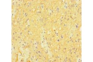 Immunohistochemistry of paraffin-embedded human glioma using ABIN7146992 at dilution of 1:100