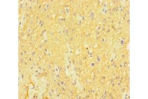 Immunohistochemistry of paraffin-embedded human glioma using ABIN7146992 at dilution of 1:100 (CTNND2 anticorps  (AA 4-308))
