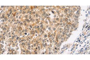 Immunohistochemistry of paraffin-embedded Human lung cancer using JNK2 Polyclonal Antibody at dilution of 1:30