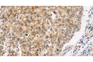Immunohistochemistry of paraffin-embedded Human lung cancer using JNK2 Polyclonal Antibody at dilution of 1:30 (JNK2 anticorps)