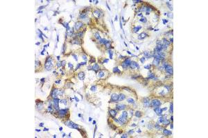 Immunohistochemistry of paraffin-embedded human liver cancer using RPL9 antibody. (RPL9 anticorps)