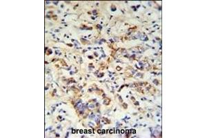 DCT Antibody (N-term) (ABIN653914 and ABIN2843150) IHC analysis in formalin fixed and paraffin embedded breast carcinoma followed by peroxidase conjugation of the secondary antibody and DAB staining.