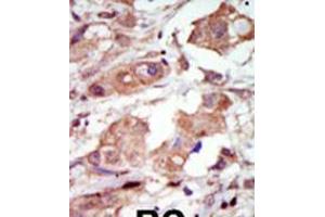 Formalin-fixed and paraffin-embedded human cancer tissue reacted with the primary antibody, which was peroxidase-conjugated to the secondary antibody, followed by DAB staining. (MAP3K10 anticorps  (C-Term))