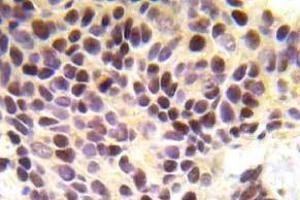 Immunohistochemistry (IHC) analyzes of BRCA1 pAb in paraffin-embedded human breast carcinoma tissue. (BRCA1 anticorps)