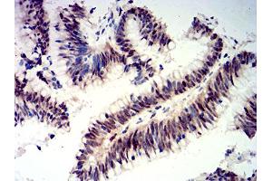 Immunohistochemical analysis of paraffin-embedded colon cancer tissues using CIRBP mouse mAb with DAB staining. (CIRBP anticorps  (AA 1-90))