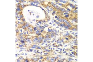 Immunohistochemistry of paraffin-embedded human gastric cancer using GLUD2 antibody at dilution of 1:100 (x40 lens). (GLUD2 anticorps)