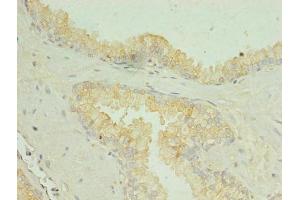 Immunohistochemistry of paraffin-embedded human prostate cancer using ABIN7169990 at dilution of 1:100