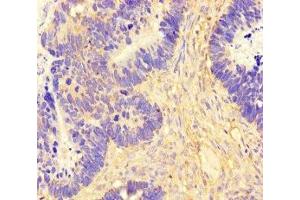 Immunohistochemistry of paraffin-embedded human ovarian cancer using ABIN7165554 at dilution of 1:100 (FAM71F2 anticorps  (AA 1-300))
