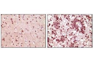 Immunohistochemical analysis of paraffin-embedded human brain tumor tissue, showing nuclear and cytoplasmic localization using ELK1 antibody with DAB staining. (ELK1 anticorps)